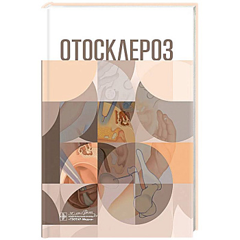 Отосклероз
